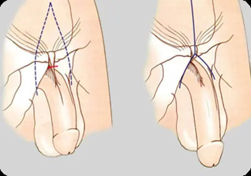 penis-buyutme-operasyonu.jpg.webp